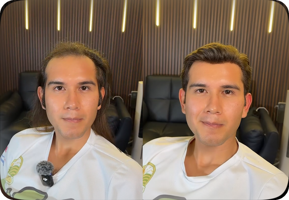 Antes y después de Alberto, de frente, con un diseño capilar a medida
