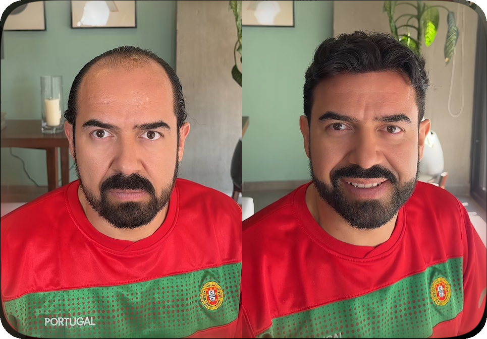 Antes y después de Joaquín, de frente, con un diseño capilar a medida